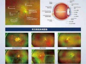 关于彩色眼底照相是否需要散瞳的探讨与解析